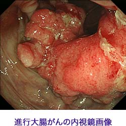 大腸癌の内視鏡画像