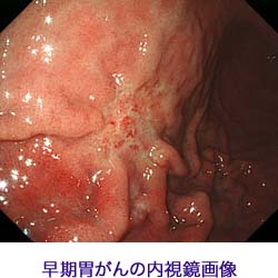 早期胃癌の内視鏡画像