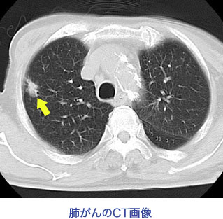 肺癌のCT画像