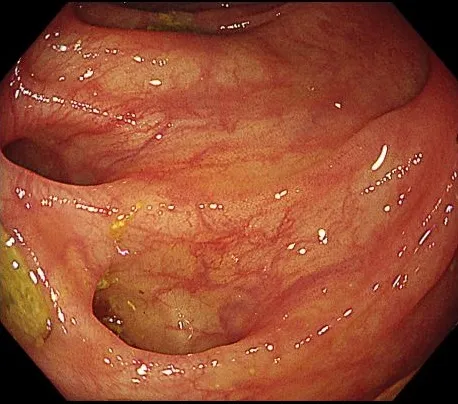 大腸内視鏡でみた大腸憩室（腸壁のくぼみ）の画像