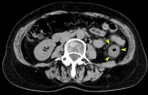 虚血性腸炎の腹部CT画像（左側結腸の腸管壁肥厚）